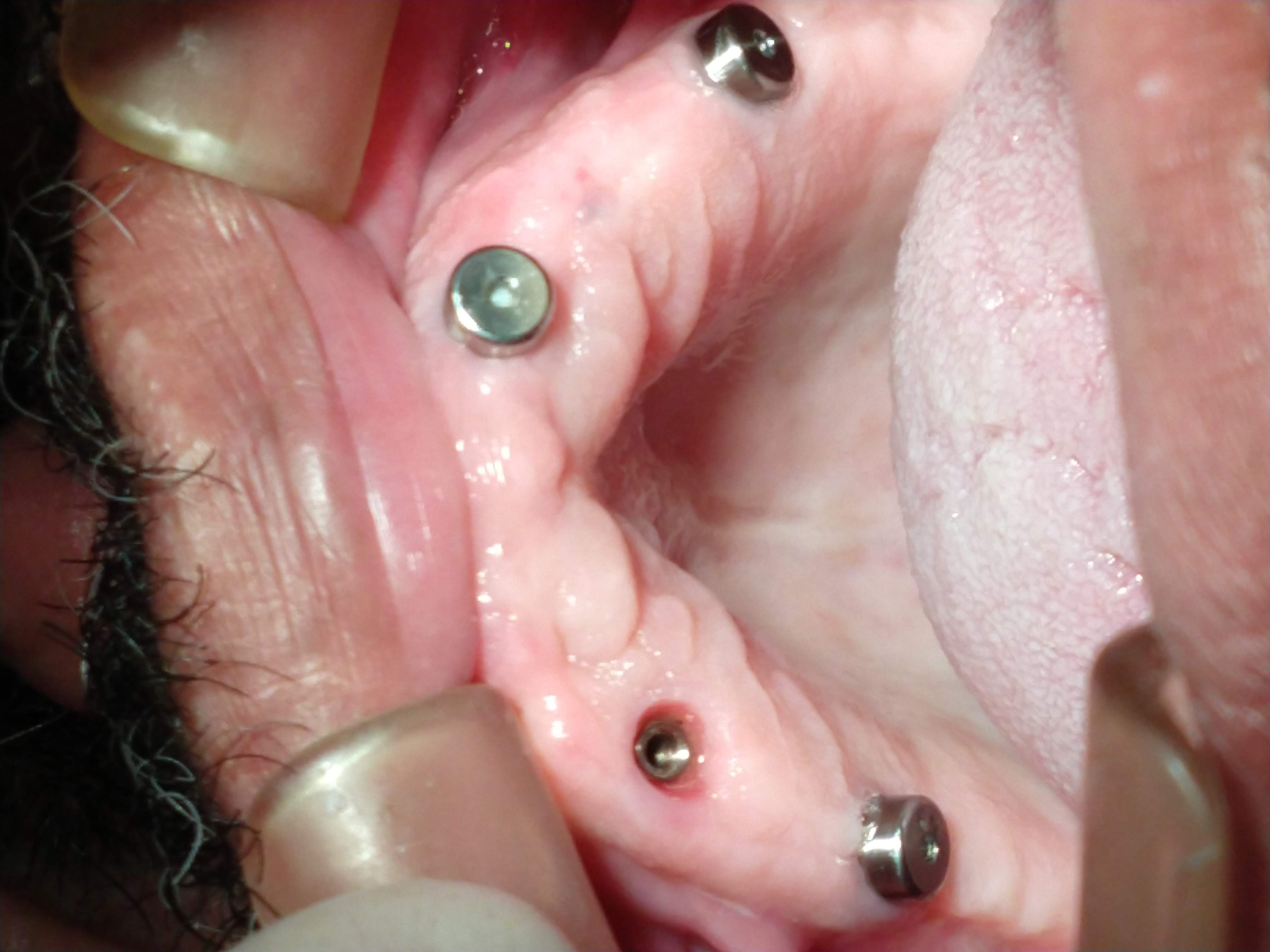 Implantes Dentários