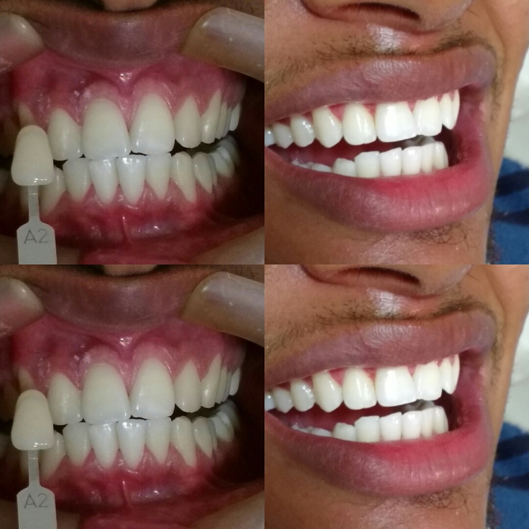 Clareamento Avançado