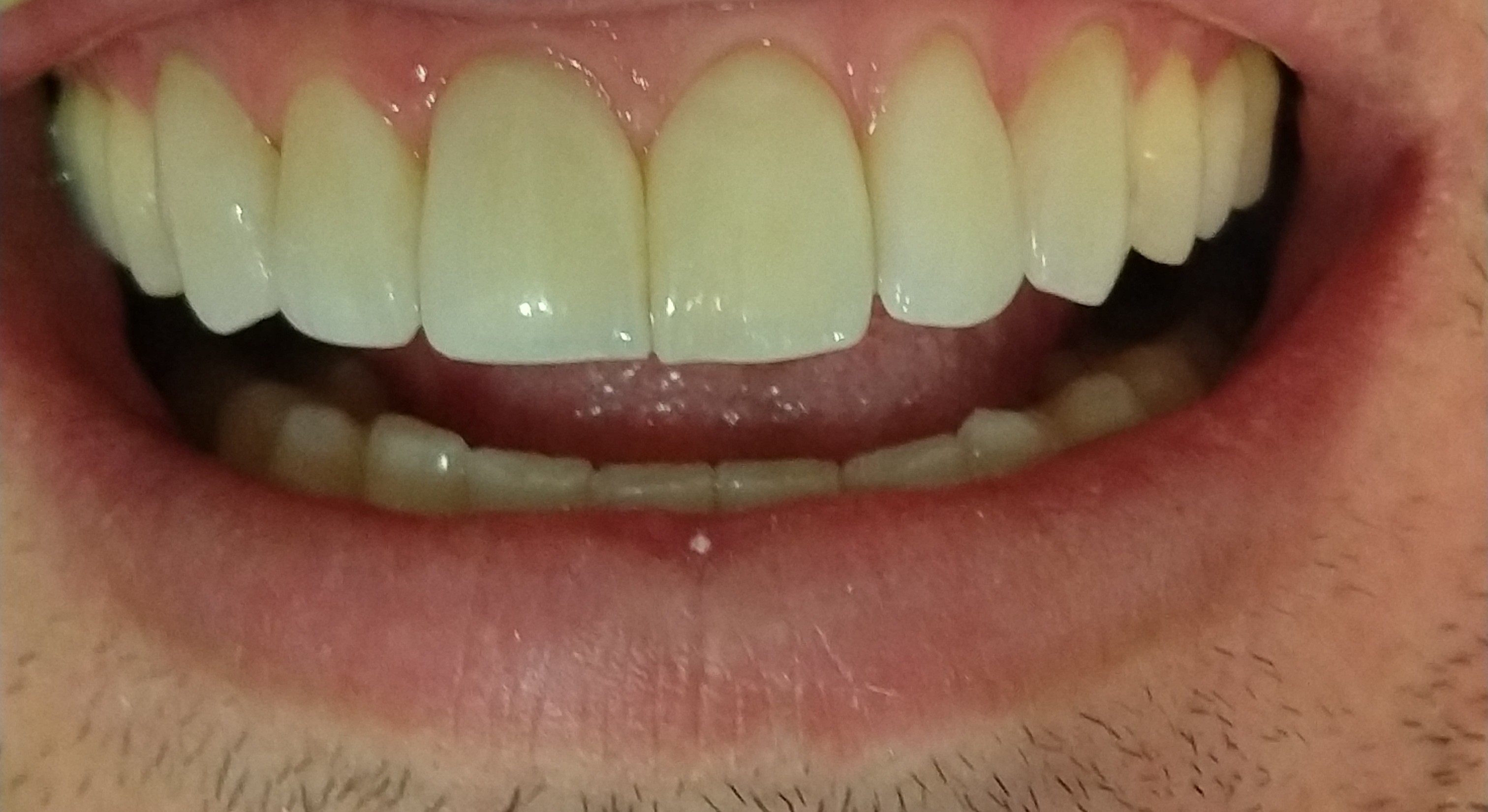 Facetas em alta qualidade