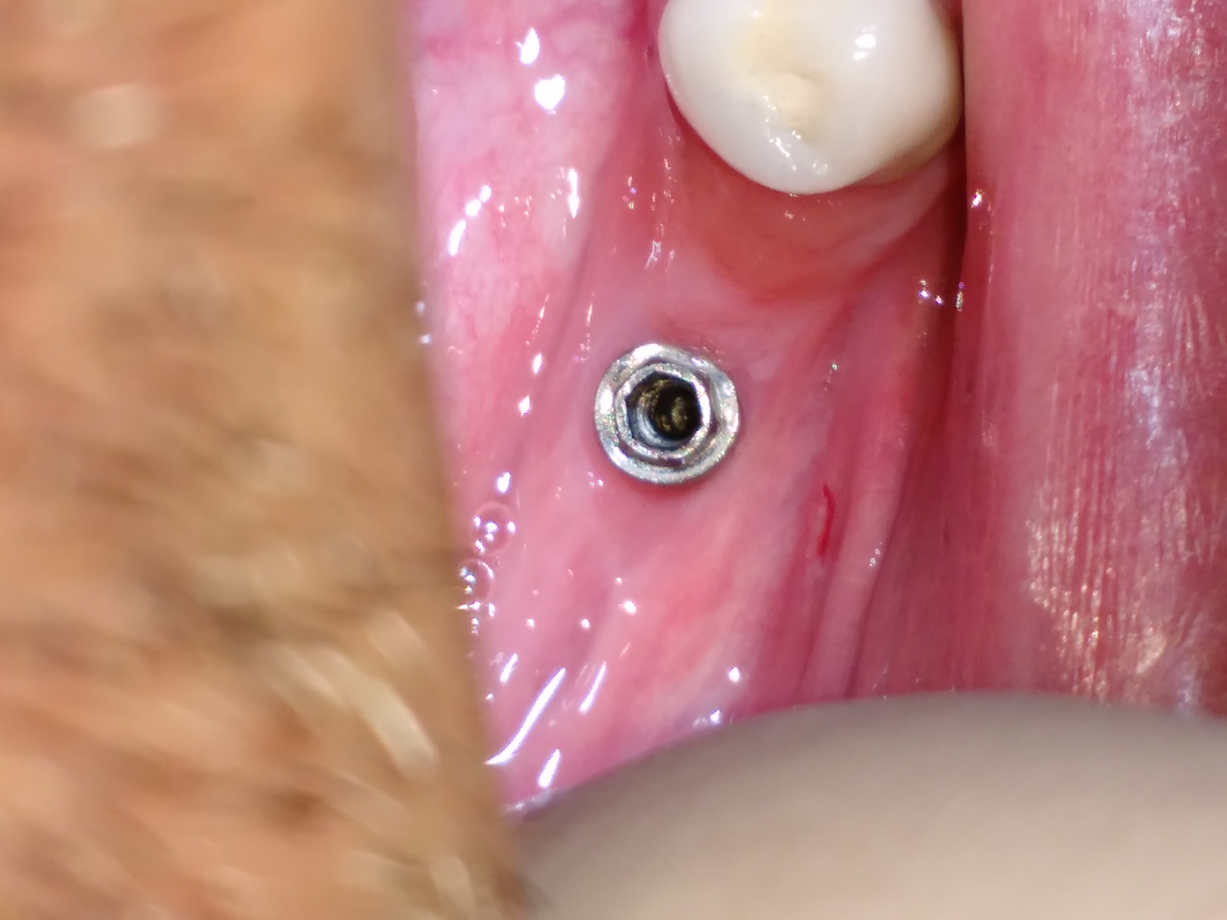 Implantes Dentários