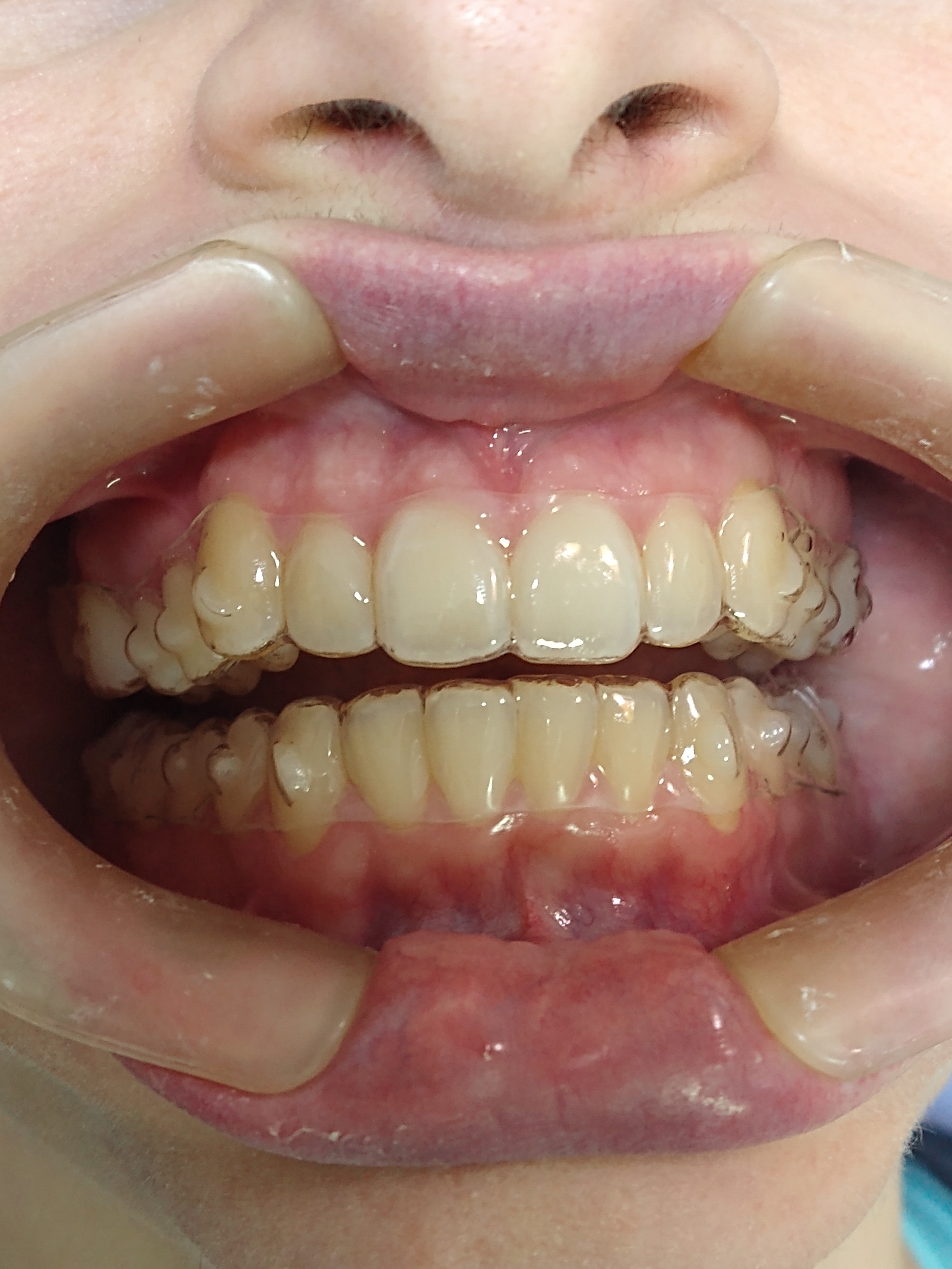 Alinhadores esteticos